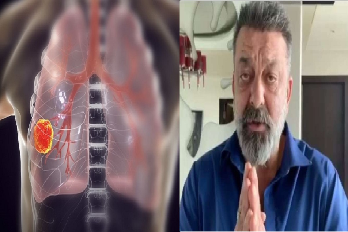 लंग कैंसर की 3 स्टेज क्या होती है? कैसे इस बिमारी से जंग जीतेंगे संजय दत्त!
