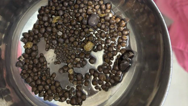 Kidney Stones 