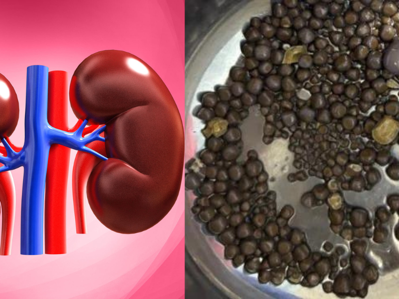 Not-One-Or-Two-But-418-Stones-Removed-From-Kidney-On-World-Kidney-Day