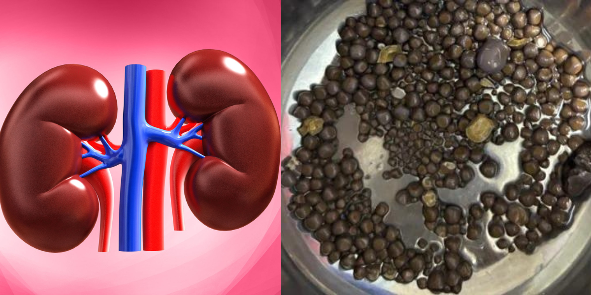 Not-One-Or-Two-But-418-Stones-Removed-From-Kidney-On-World-Kidney-Day