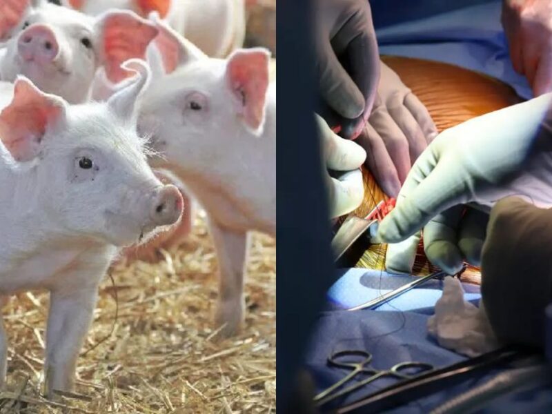 Doctors Did A Great Job In An American Hospital, Transplanting Pig Kidney Into A Human.