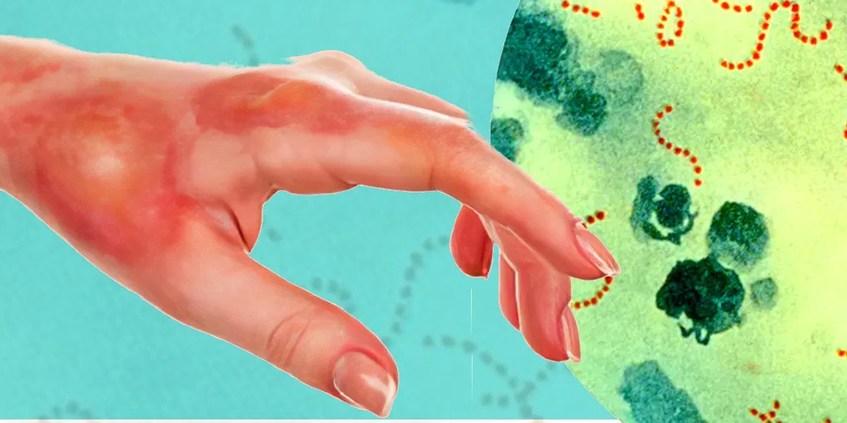 Spreads Stss Bacteria In Japan 