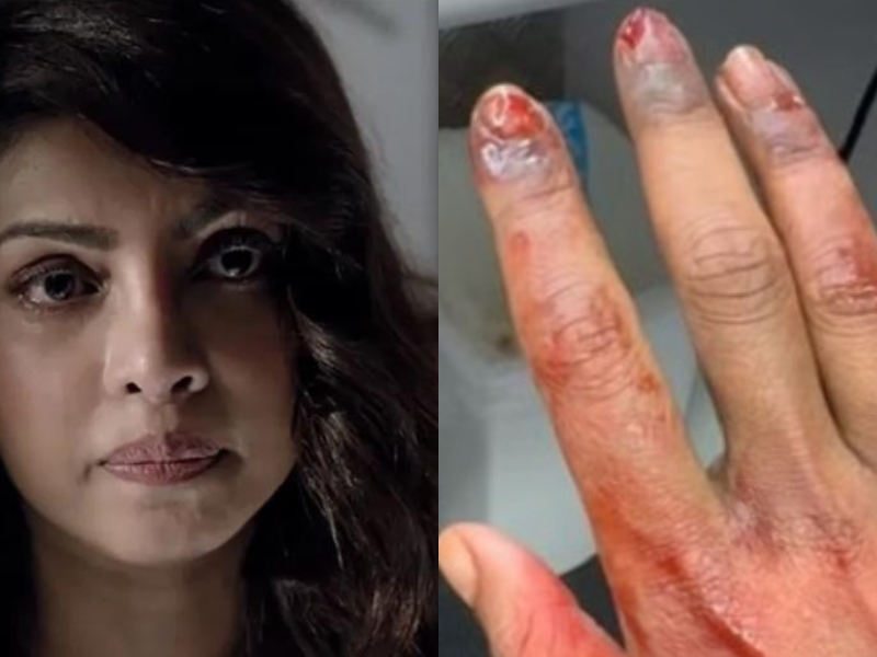 Priyanka-Chopra-Got-Badly-Injured-Face-Soaked-In-Blood-Swollen-Fingers-Fans-Got-Scared-After-Seeing-Such-Condition-Of-The-Actress
