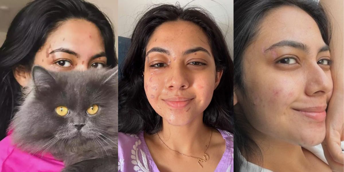 Reem-Shaikh-This-Famous-Actress-Was-Not-Fit-To-Show-Her-Face-To-Anyone-Boiling-Oil-Fell-On-Her-Face-This-Is-What-Happened