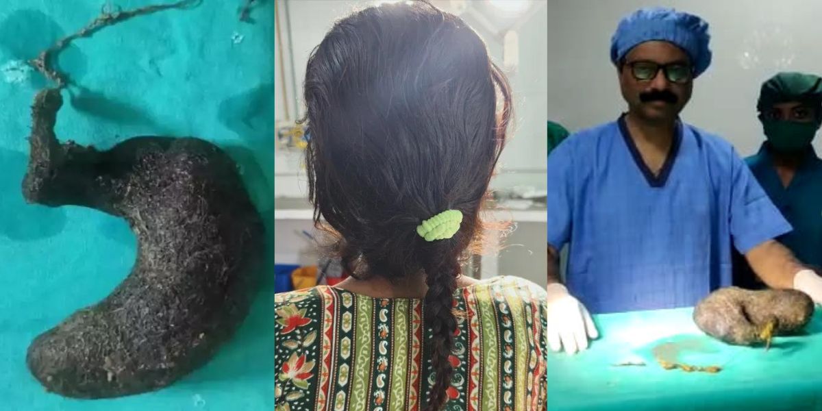 Hair In Woman'S Stomach 2.5 Kg Hair Came Out Of The Stomach Of A 21-Year-Old Girl, Even The Doctors Were Shocked