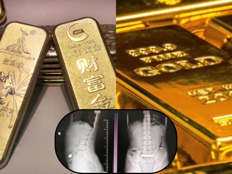 China-News-Gold-Brick-Was-Found-In-Boy-Stomach