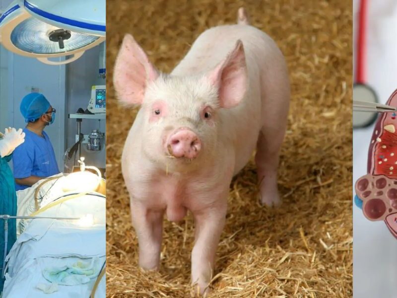 Pig'S Kidney Saved A Woman'S Life For 130 Days, Then Something Happened That Stunned Doctors