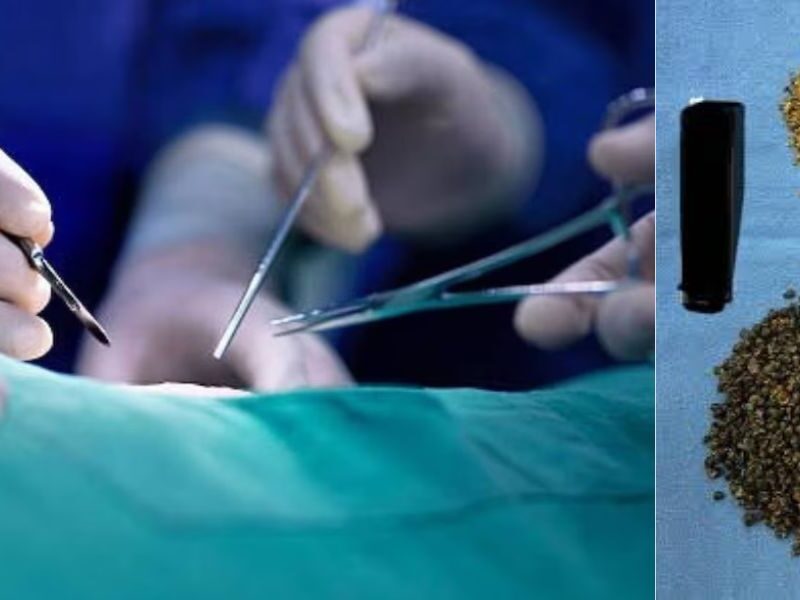 Gurugram-News-8125 Stones Were Removed From A 70 Year Old Man Through Stone Operation