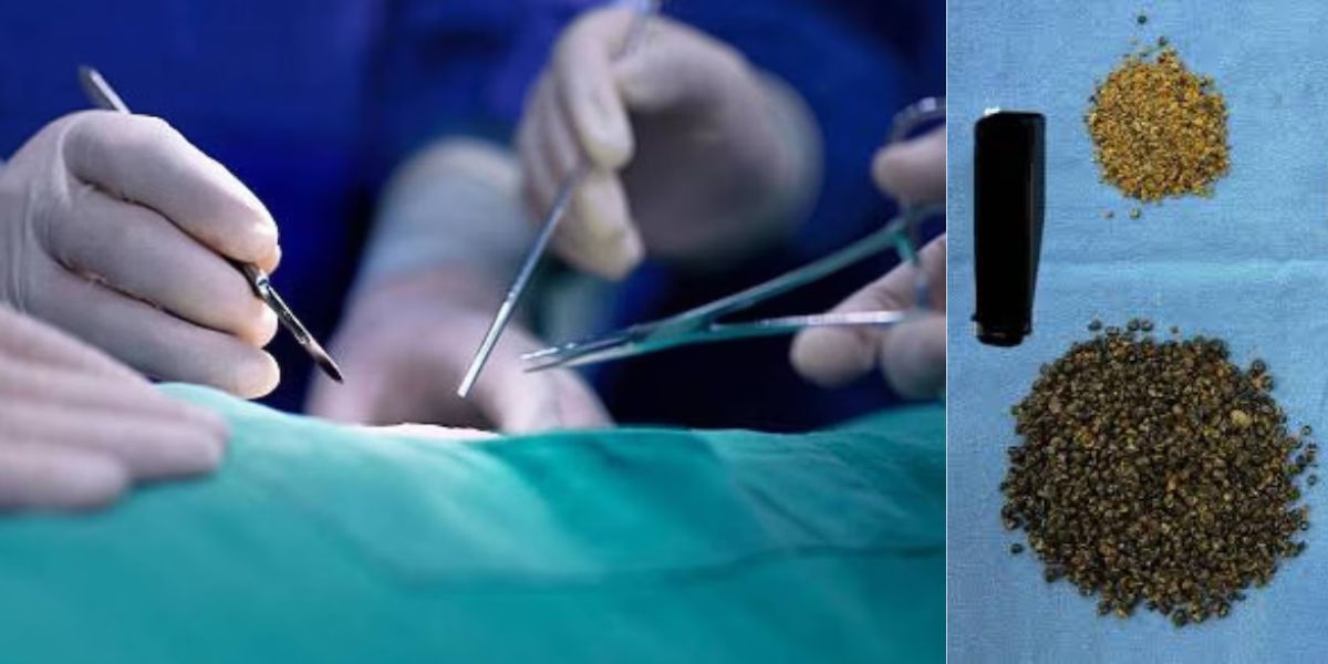 Gurugram-News-8125 Stones Were Removed From A 70 Year Old Man Through Stone Operation