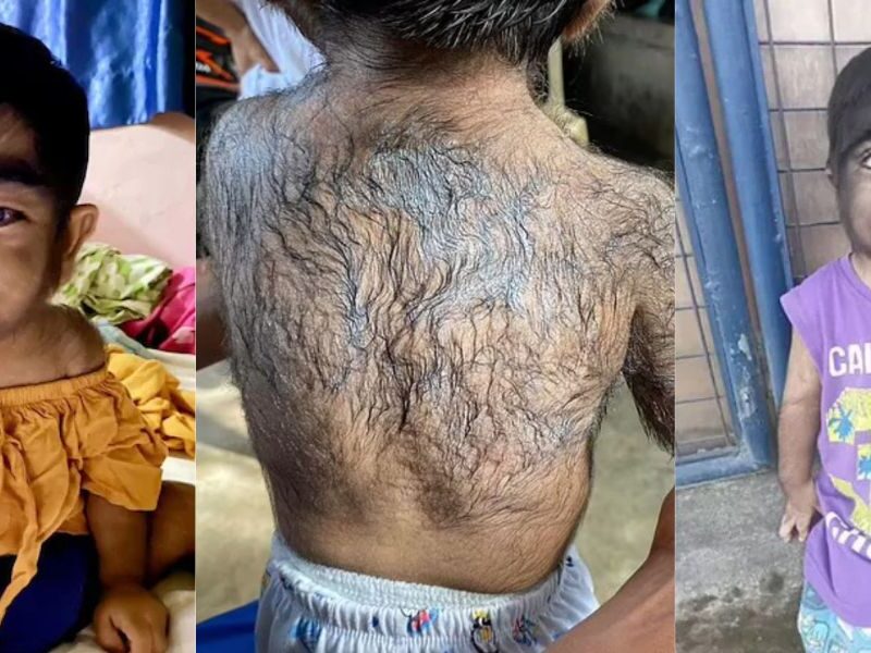 Viral-News-A Unique Disease Changed The Appearance Of The Child