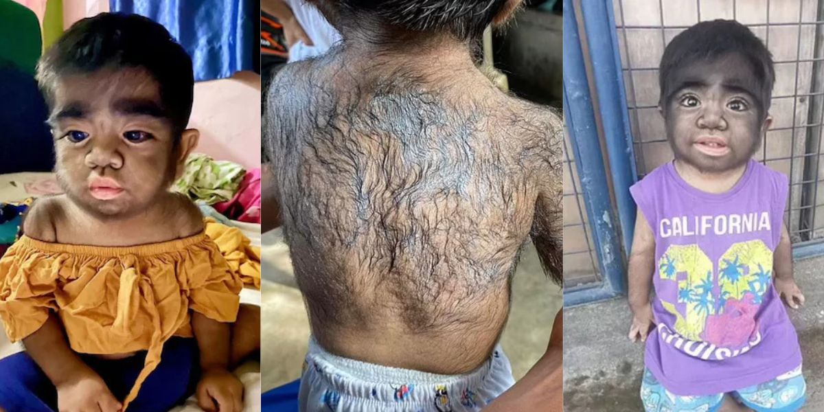 Viral-News-A Unique Disease Changed The Appearance Of The Child