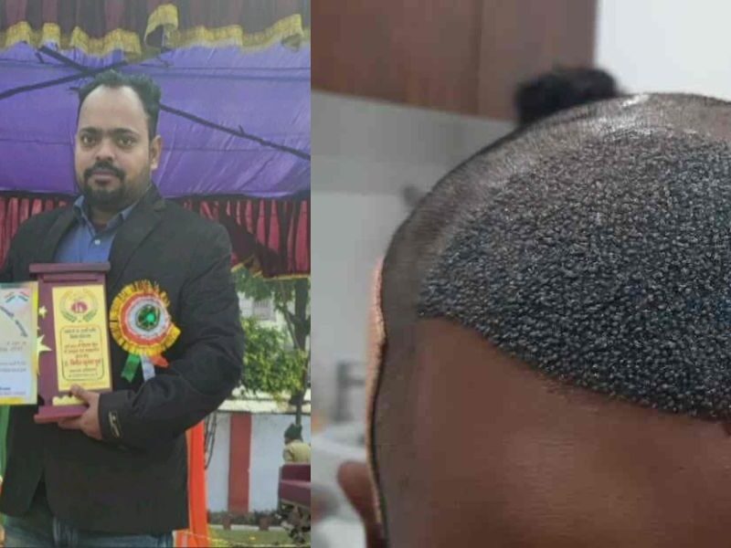 An Engineer Died A Painful Death Within 15 Days Of Hair Transplant