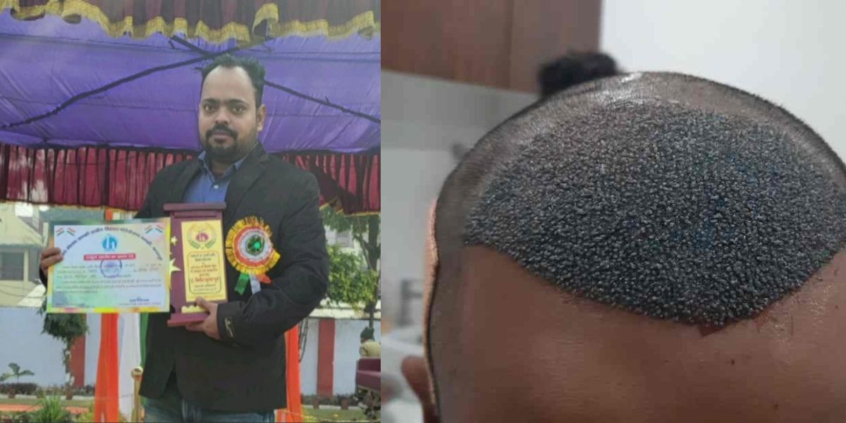 An Engineer Died A Painful Death Within 15 Days Of Hair Transplant