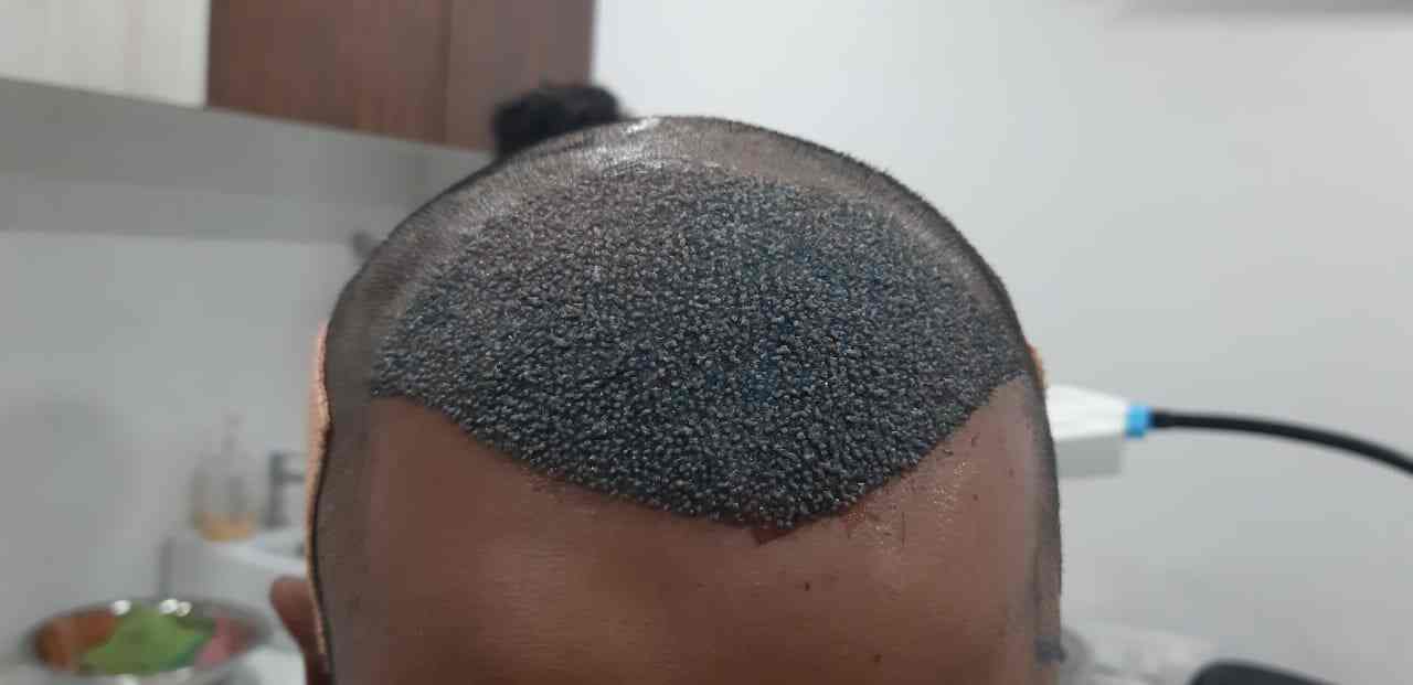 Hair Transplant