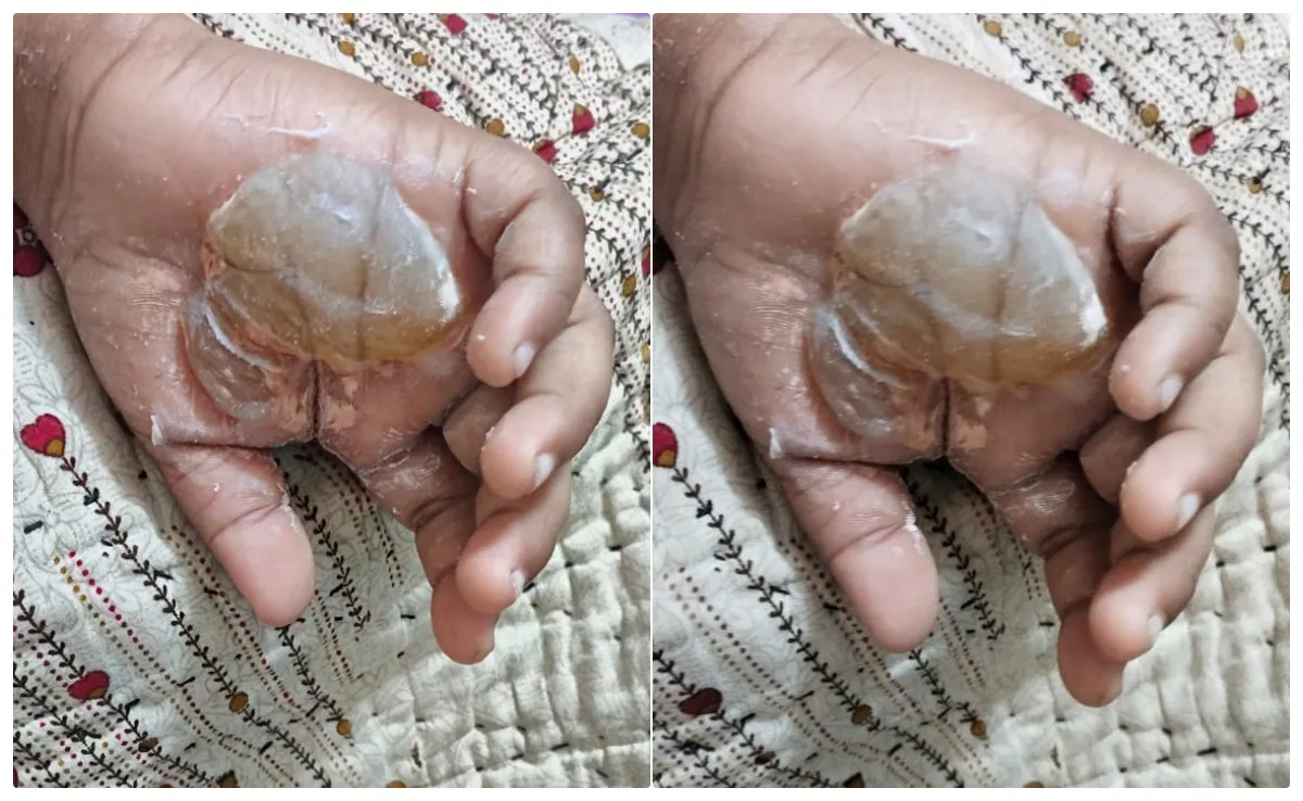 Teacher Burns Student'S Hands