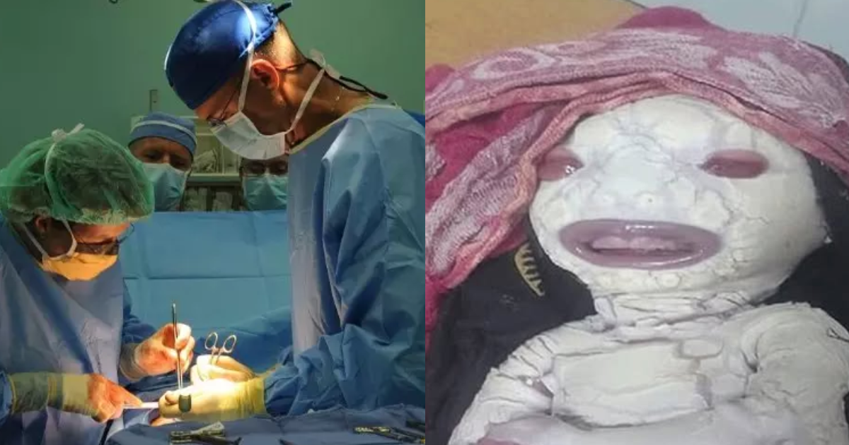 A Woman Gave Birth To A Child Who Looks Like An Alien, Even Doctors Were Shocked To See His Face