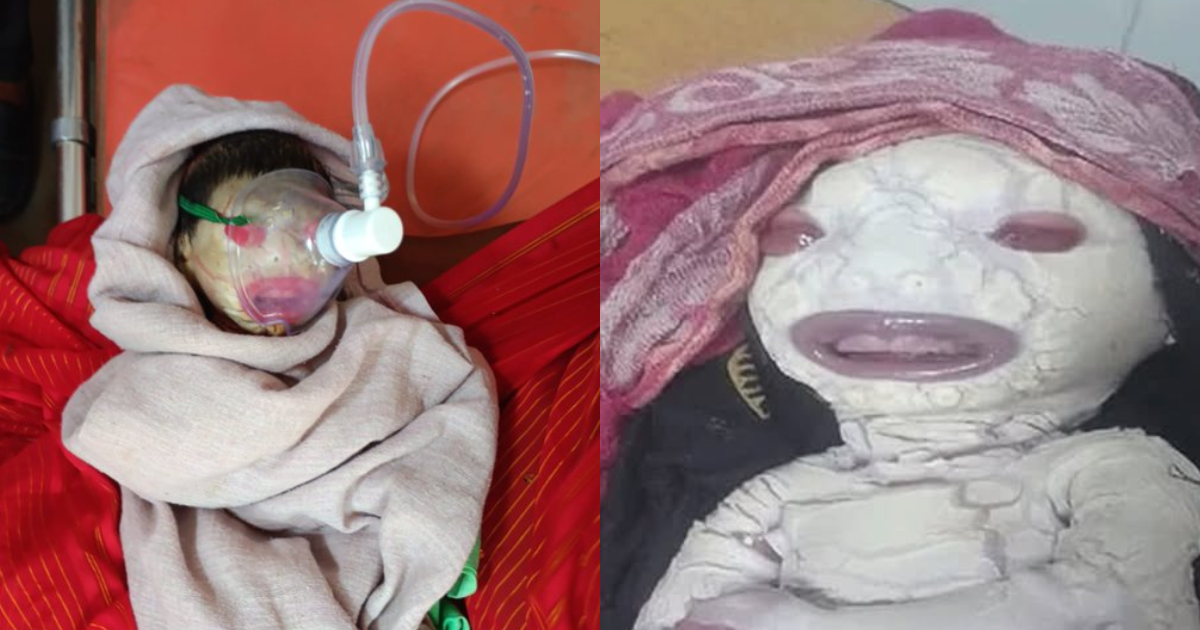 In Rewa, A Woman Gave Birth To An Alien-Like Child