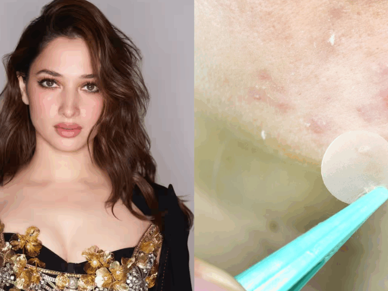 Tamannaah Bhatia Uses Spit To Cure Pimples, Know Which Other Home Remedies Are Effective
