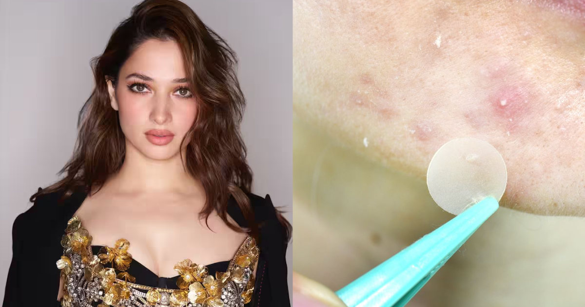 Tamannaah Bhatia Uses Spit To Cure Pimples, Know Which Other Home Remedies Are Effective