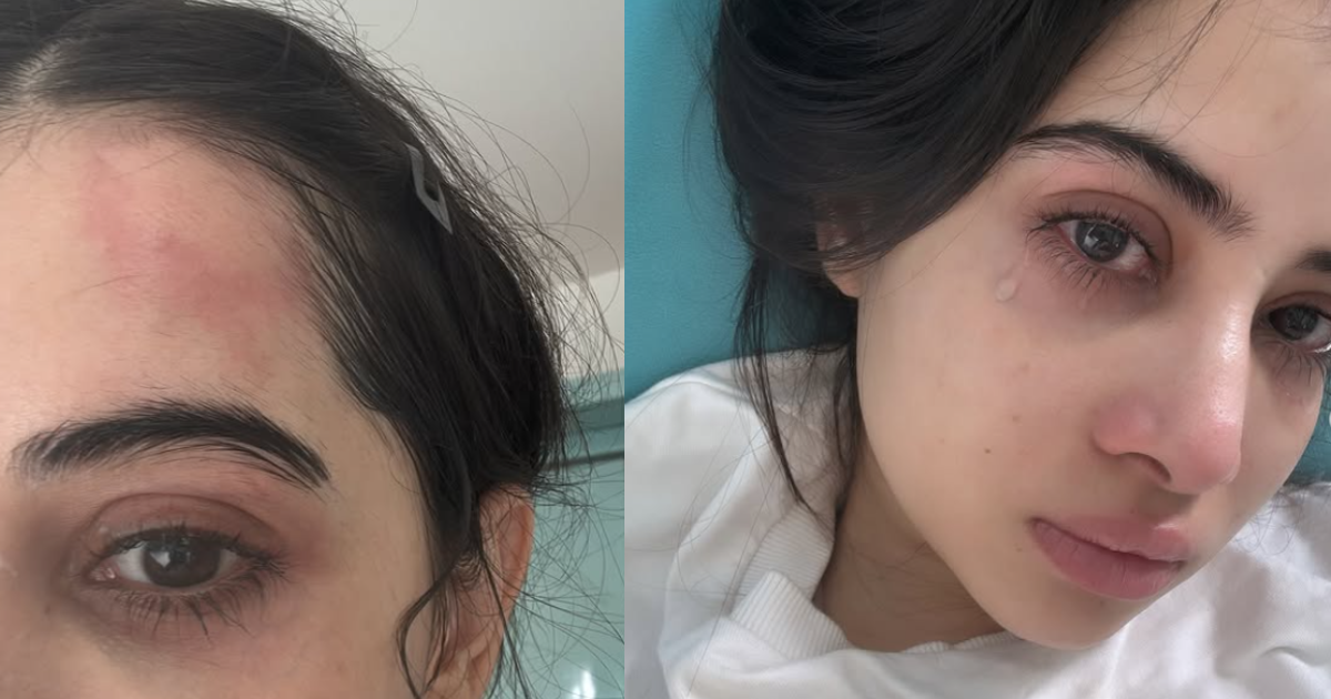 Urfi Javed Was Beaten Up! Injury Was Seen On The Head